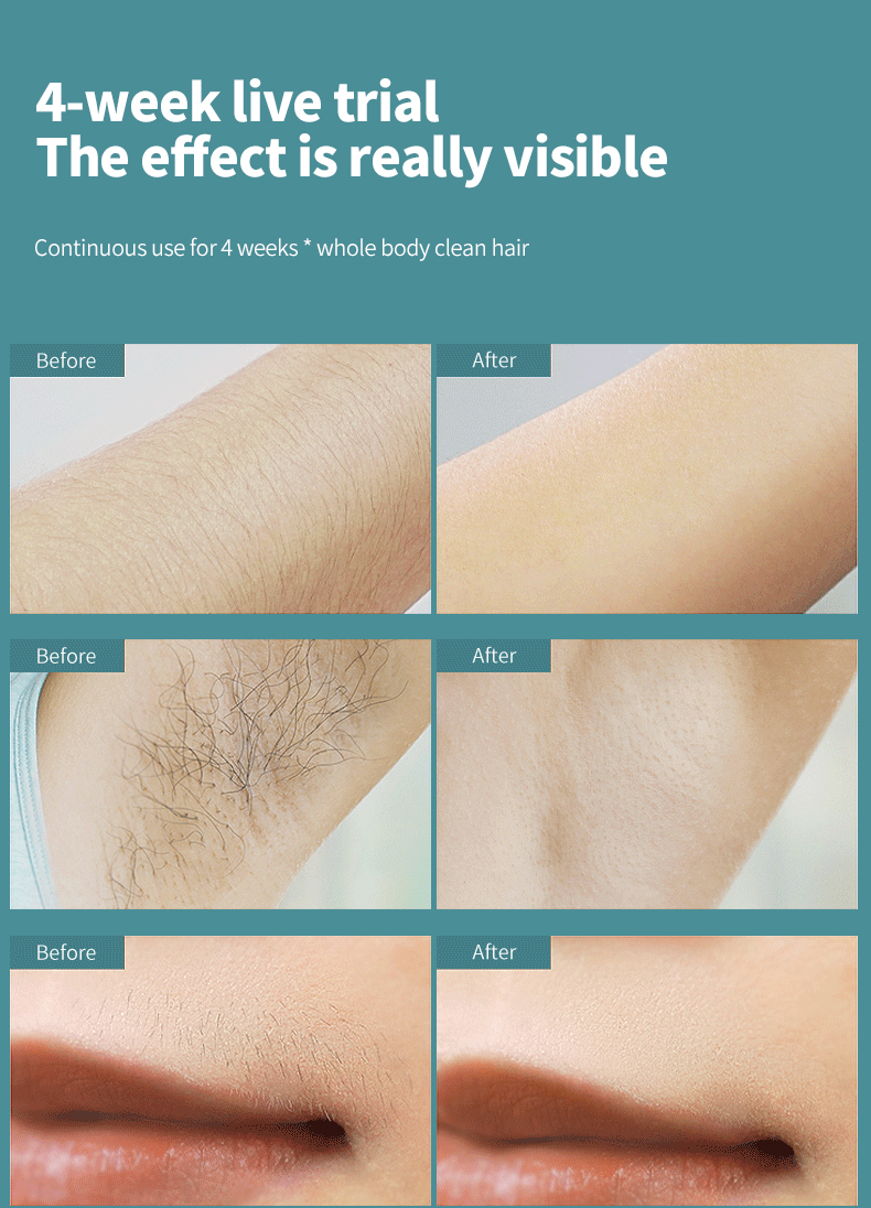 Laser Hair Removal Instrument Persistent Net Effect Say Goodbye To ...